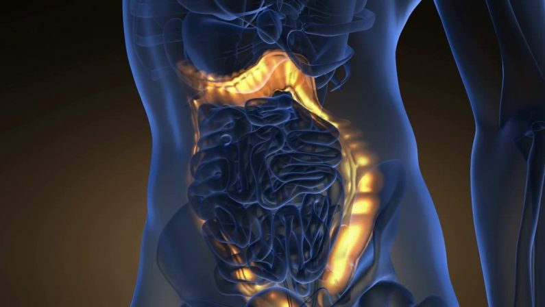 Tumore del colon: microbiota responsabile delle metastasi al fegato